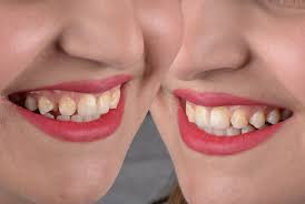 life style dentistry enhancing your smile now